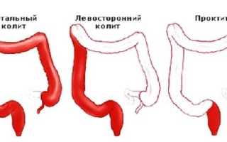 Причины и лечение воспаления прямой кишки или проктита