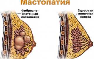 Может ли фиброзно-кистозная мастопатия перерасти в рак и чем еще опасна данная патология + методы ее лечения