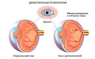 Препролиферативная и непролиферативная диабетическая ретинопатия