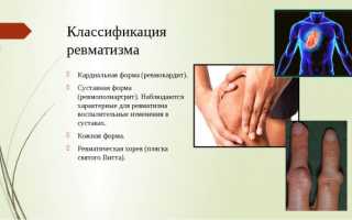 Ревматизм: симптомы у взрослых, виды и формы, осложнения, диагностика, лечение