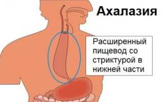 Ахалазия пищевода: лечение современными методами и их суть