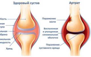 Артрит коленного сустава: особенности развития и лечения заболевания