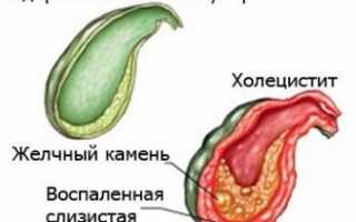 Какие лекарственные препараты эффективно лечат холецистит