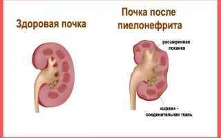 Неотложная помощь при остром пиелонефрите и гематурии